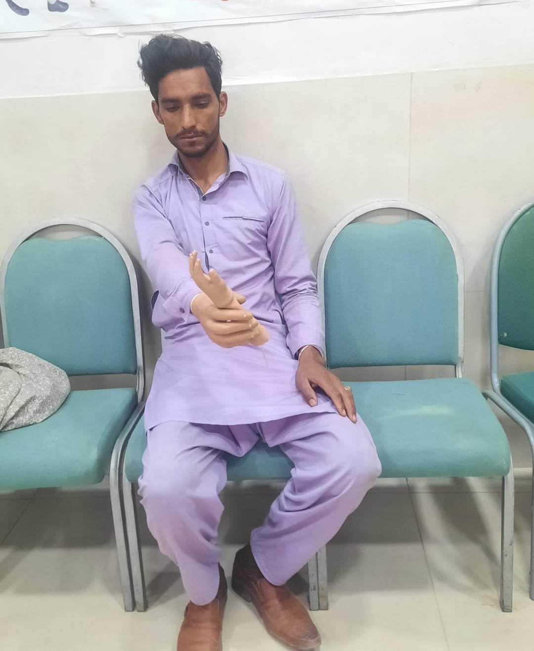 Upper Limb Prosthesis